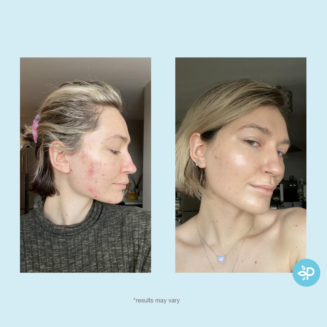 Hydro-Glo Peel Pads - Enhanced with Kojic, Mandelic, Glutathione, Licorice, Papaya, Pineapple, Bearberry Extracts (10% Strength Peel)