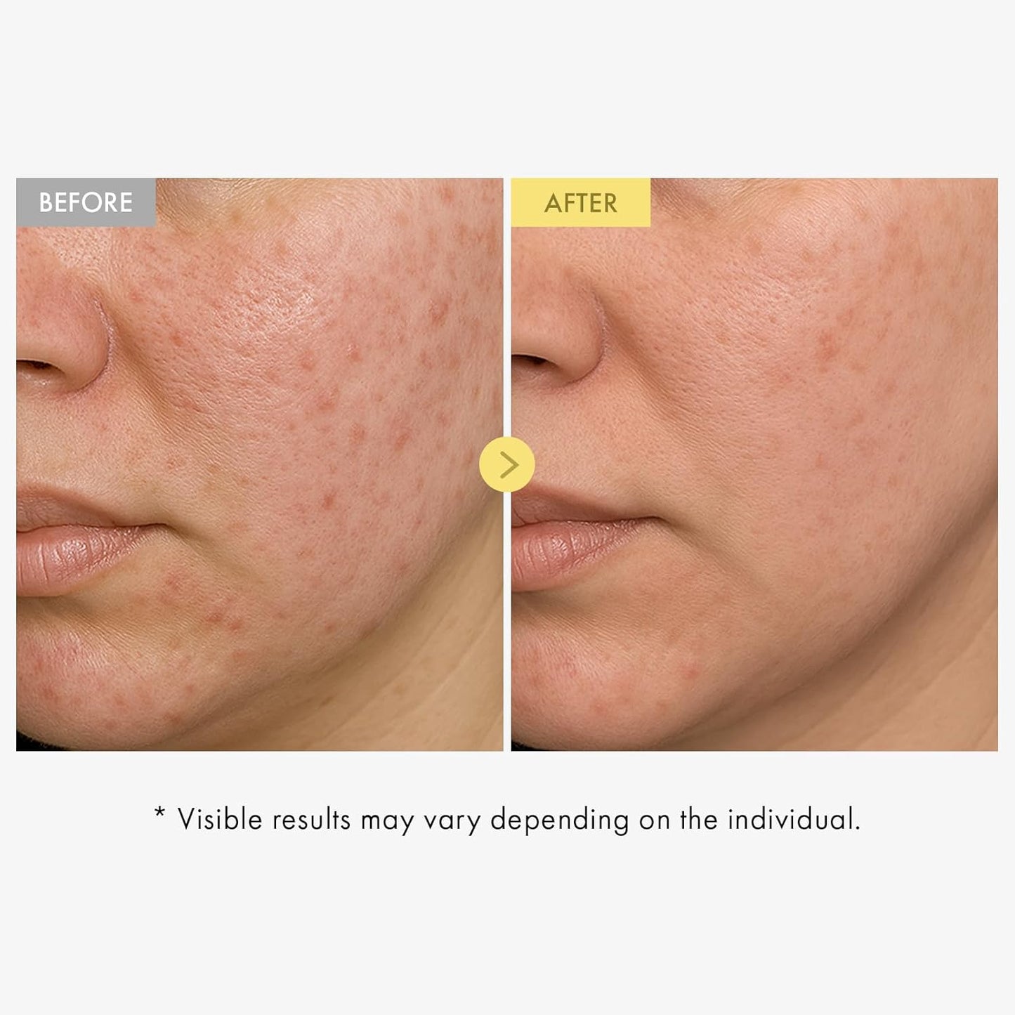 Honey Glow 65% Propolis Serum, Hyaluronic Acid, Kojic Acid, Niacinamide, Hydrating Facial Soothing Moisturizer for Irritated Uneven Skin Tone, Glass Skin, Korean Skin Care, 33ml, 1.11 fl.oz.